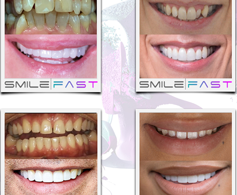 before and after photos for composite bonding