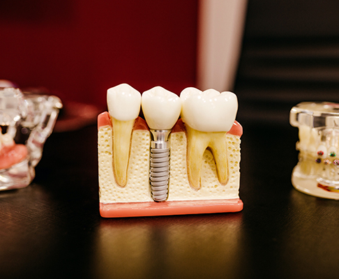 Model of dental implants