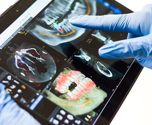 Dental xrays of implants