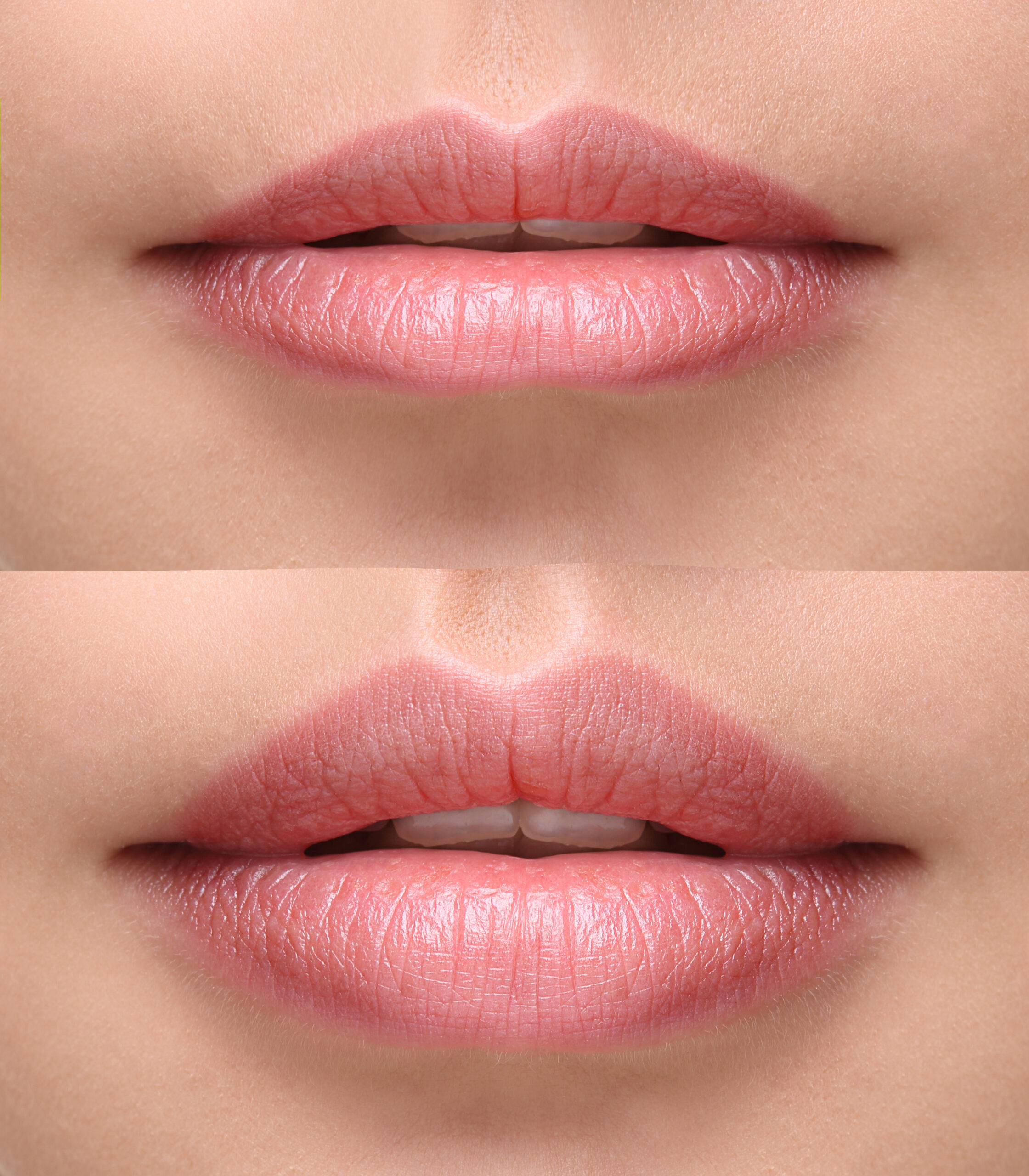 Image of lips before and after botox and dermal fillers