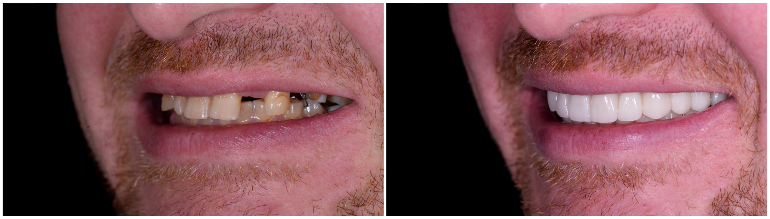 before and after teeth photo