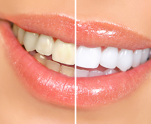 Before and after photos of teeth whitening