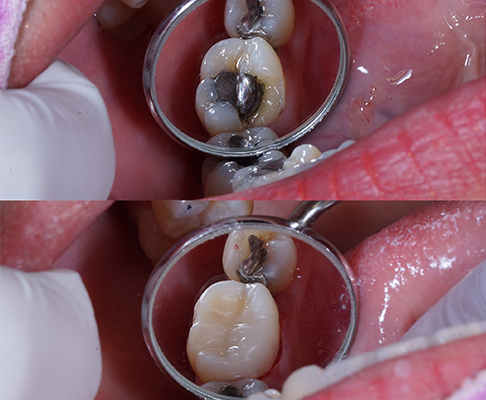 Image of composite filling