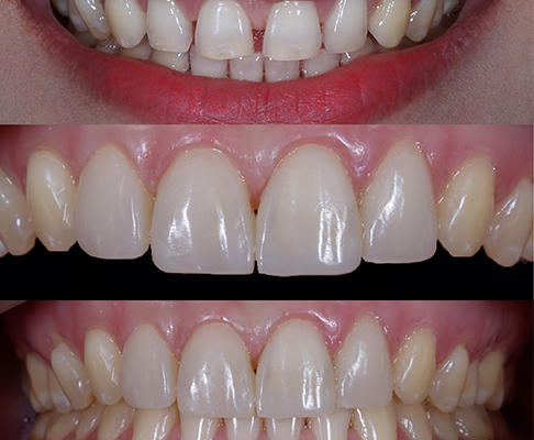 Before and after teeth images