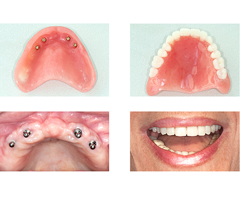 Photos showing dental implants