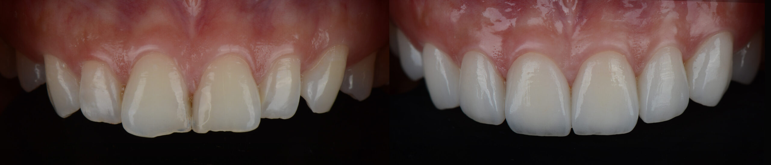 Photograph of teeth with porcelain veneers
